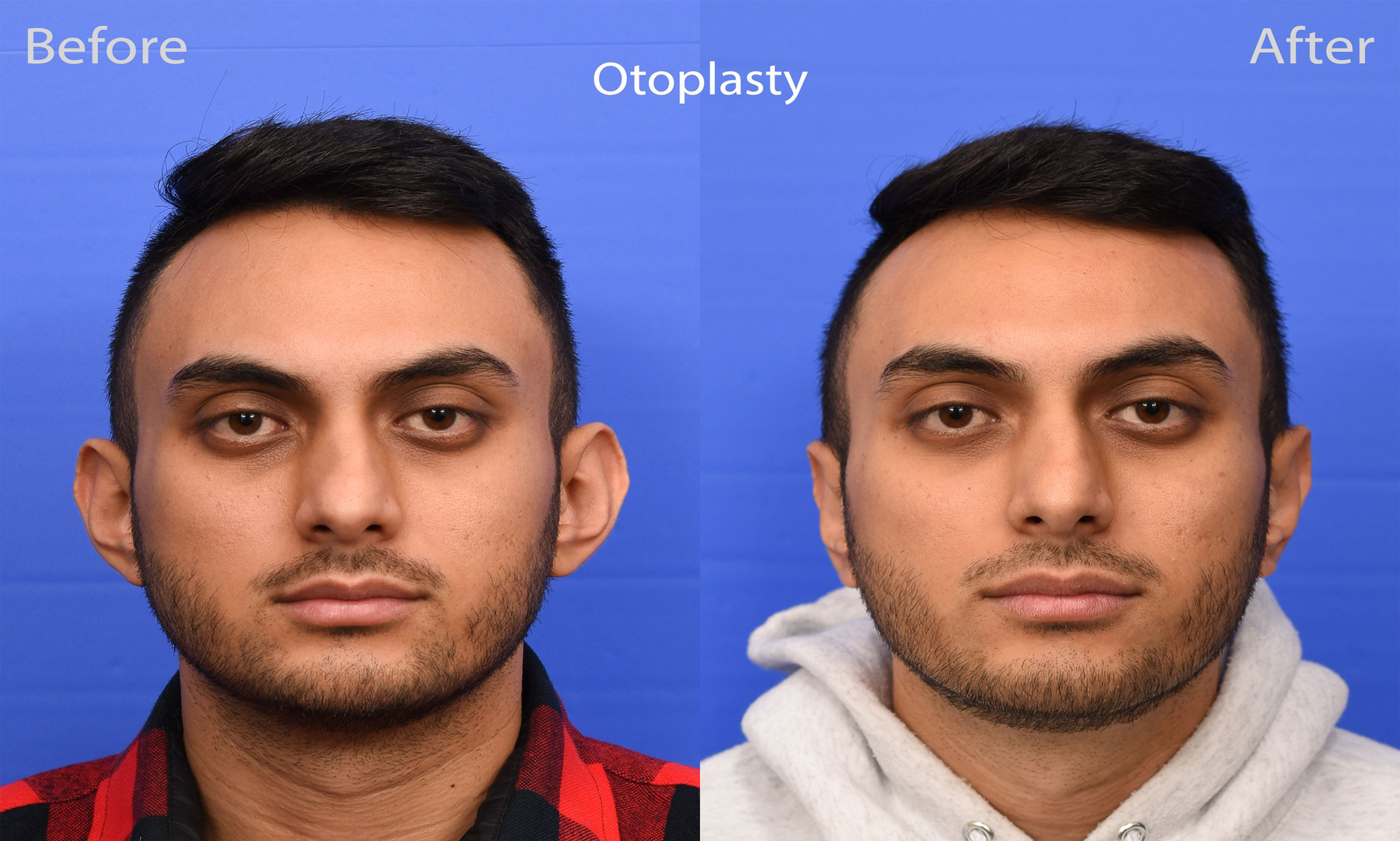 otoplasty treatment in Bangladesh