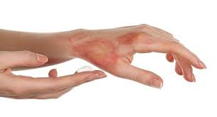 hand burnt instant treatment